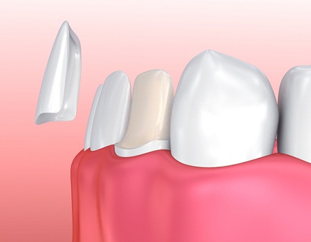 Digital image of a veneer being place on a front tooth