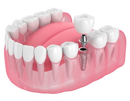 Illustration of a single dental implant
