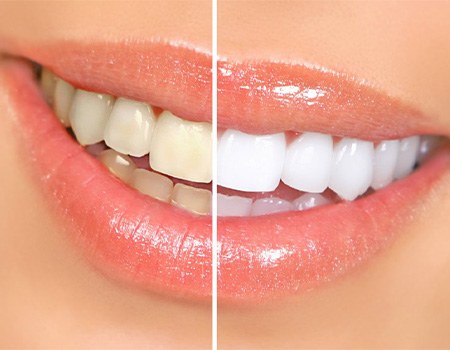 Before and after teeth whitening