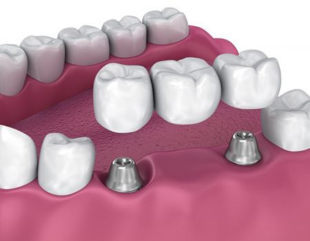 Digital image of a dental bridge hovering above two dental implants