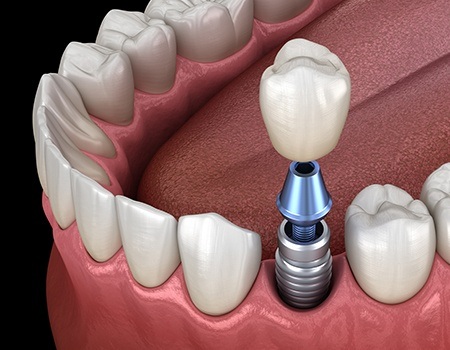 Animation of implant supported dental crown placement