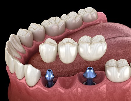 Animation of implant supported fixed bridge placement