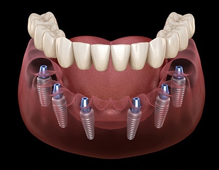 Animation of implant supported denture placement