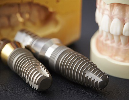 Model smile and model dental implant posts
