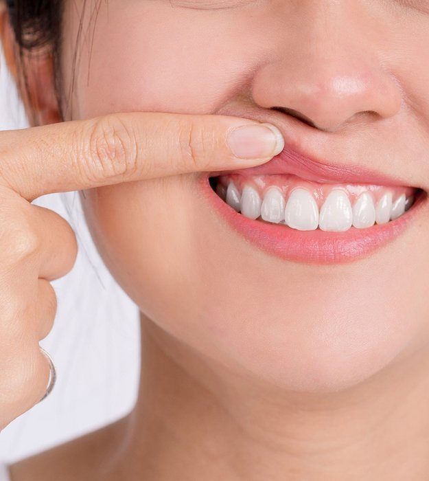 Woman showing off her gums