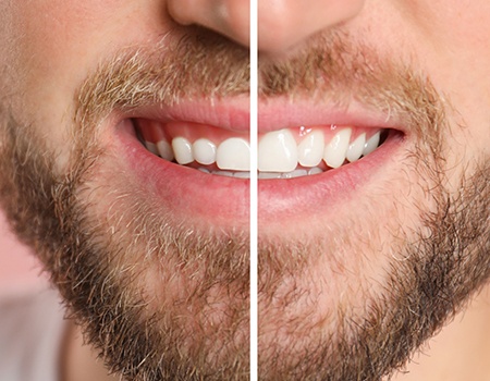 Before and after gum recontouring