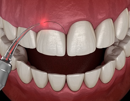 Illustration of laser gum recontouring
