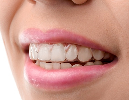 Woman with Invisalign tray