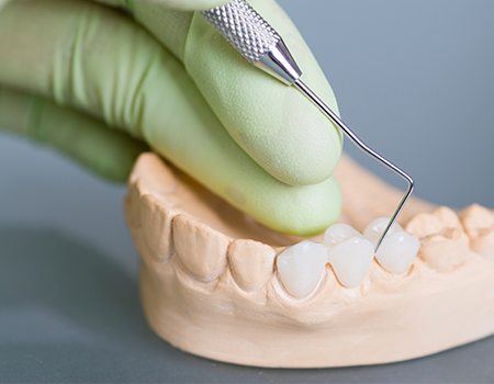 Model smile with fixed bridge restoration