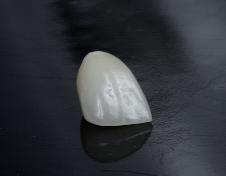 Single porcelain veneer on a black background