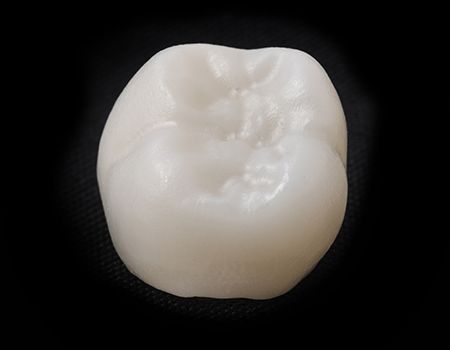 Tooth-colored dental crown prior to placement