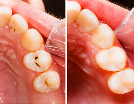 Closeup of teeth before and after filling placement