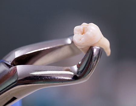 Clasp holding extracted tooth