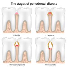Illustration of the stages of gum disease a dentist uses to explain the condition