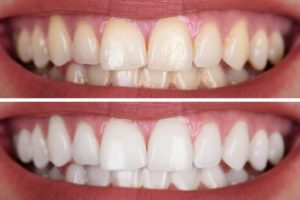 A “before and after” of teeth that were whitened