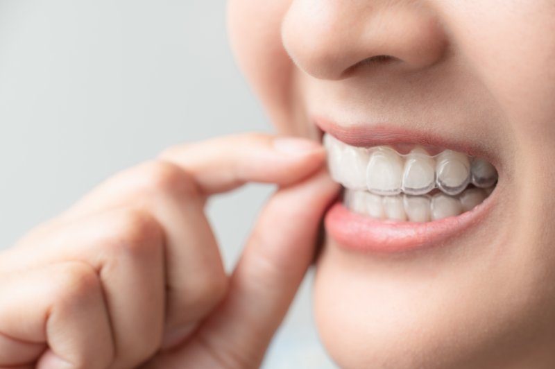 a person wearing Invisalign in Spring House