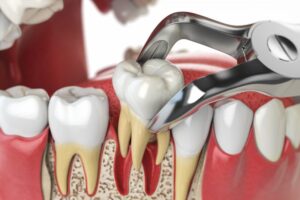 Animated model of tooth being extracted. 