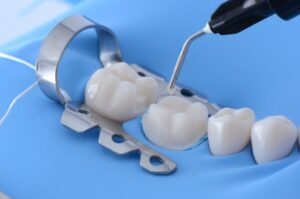 Dental bonding procedure.